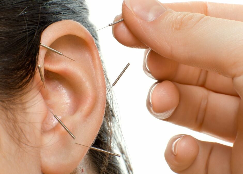 auriculotherapie acuponcture
