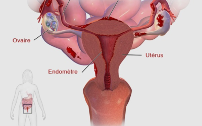 Endométriose : Le mal invisible qui affecte des millions de femmes